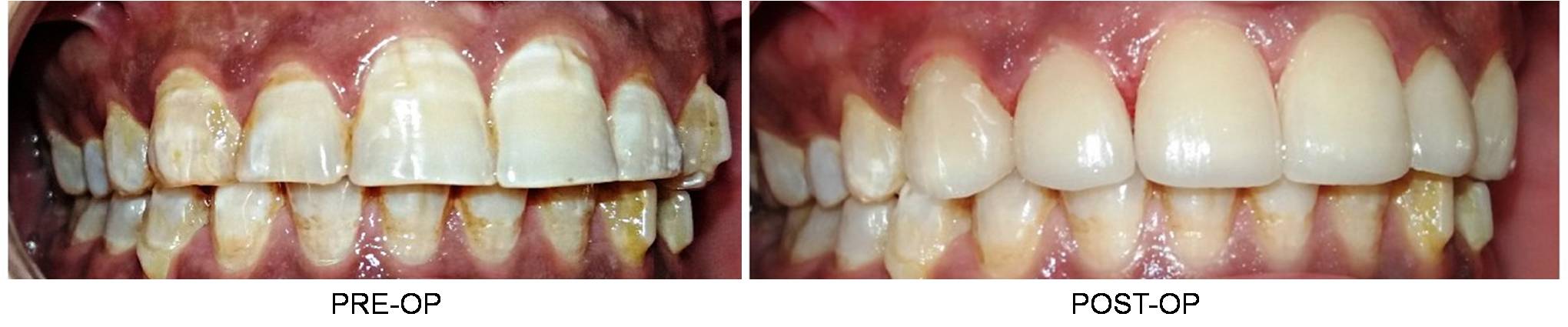 Dental Veneers in Delhi Before and After