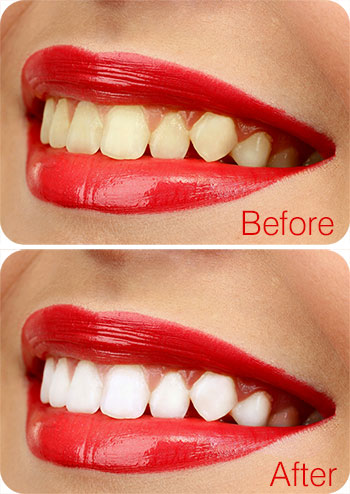 Teeth Whitening in Delhi - Before and After